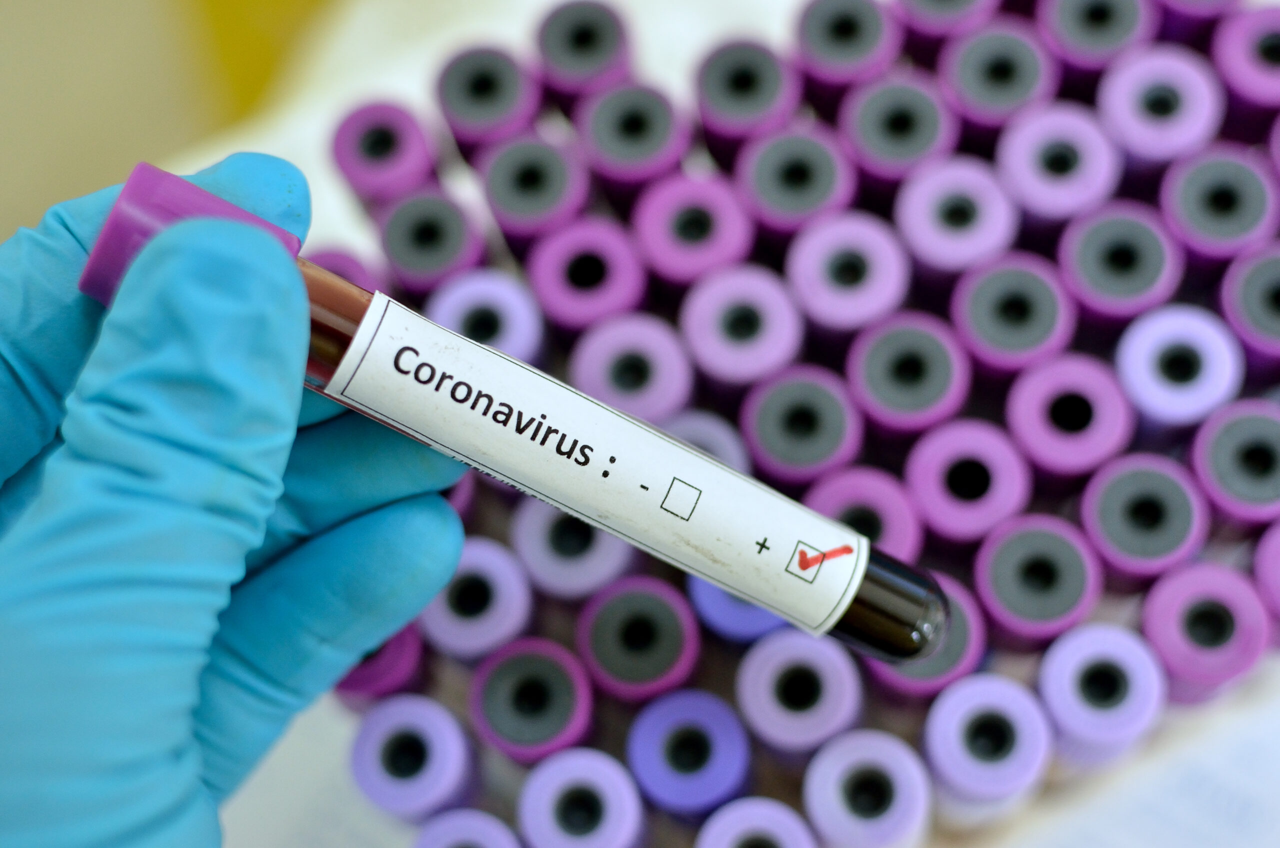 coronavirus sample viles scaled